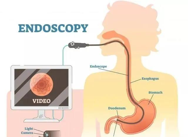 為什么說胃腸鏡是救命的檢查?90%的疾病都集中在消化道!