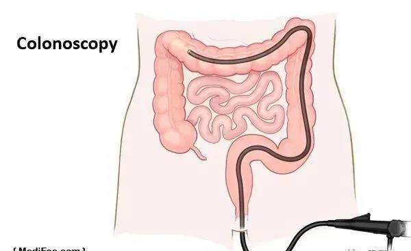 為什么說胃腸鏡是救命的檢查?90%的疾病都集中在消化道!